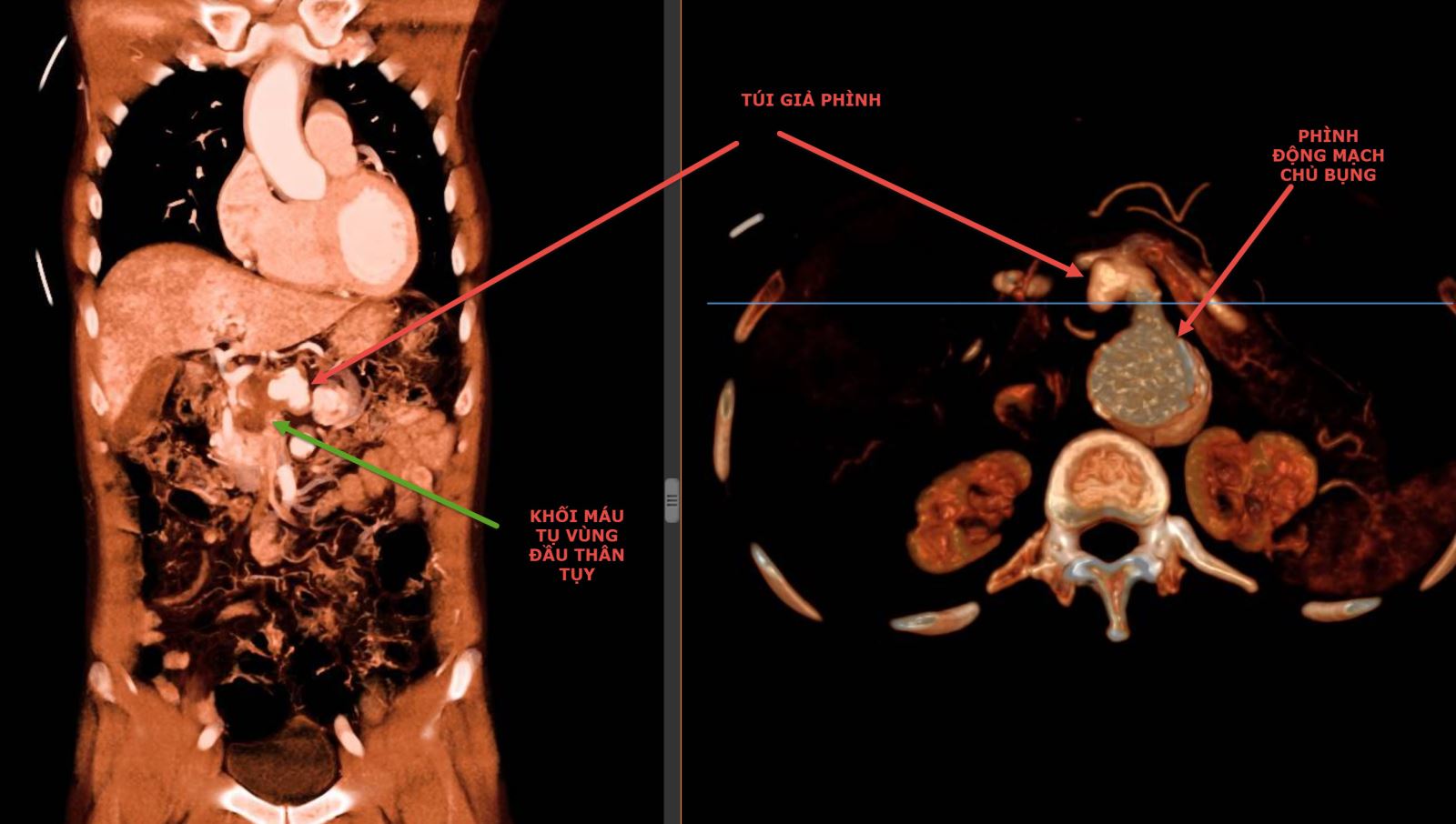 Hình CT cho thấy khối giả phình và khối máu tụ của người bệnh trước can thiệp.jpg